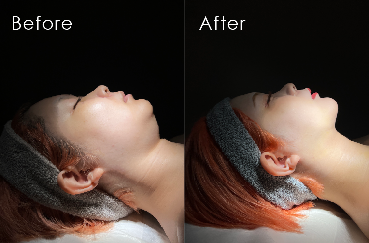 まゆごんさん顔 脂肪吸引Before・After