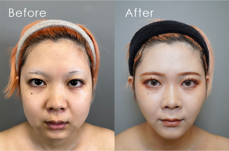 まゆごんさん顔 脂肪吸引Before・After
