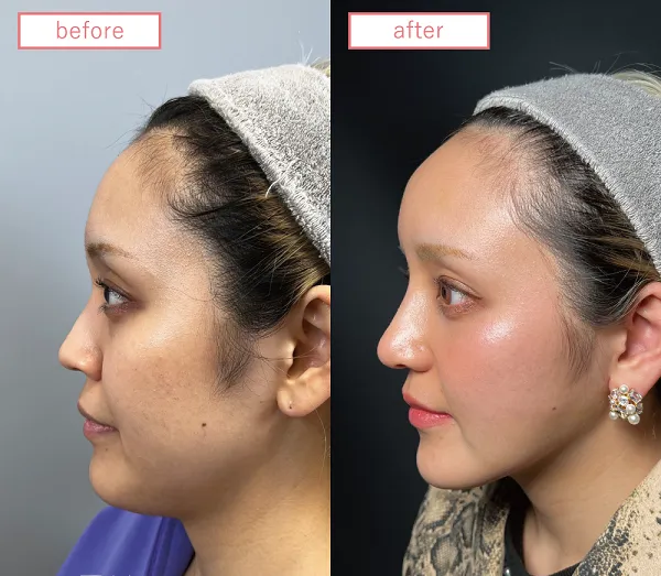 岡山院糸リフト+顔脂肪吸引