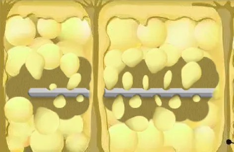 アーキセル脂肪吸引イメージ