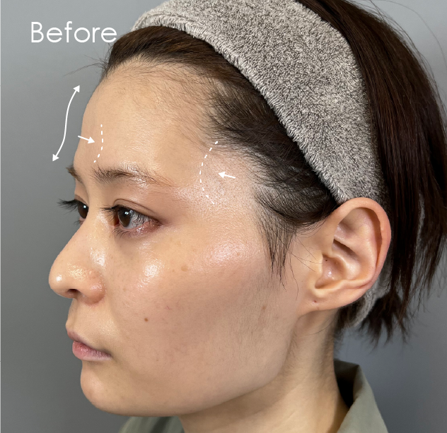 おでこの脂肪注入before