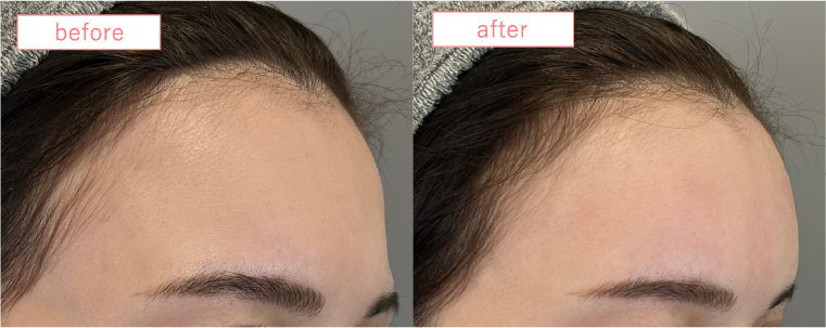 額の脂肪注入症例