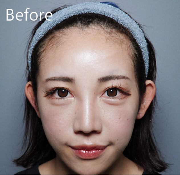 おでこのヒアルロン酸before
