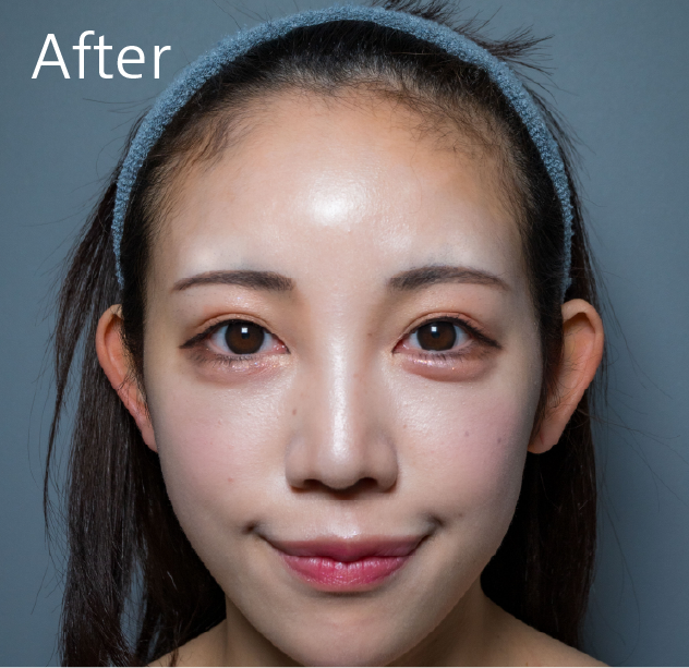 おでこのヒアルロン酸after