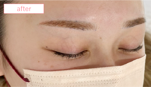 アートメイク症例アフター