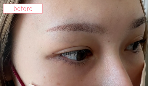 アートメイク症例ビフォアー