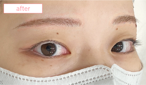 アートメイク症例アフター