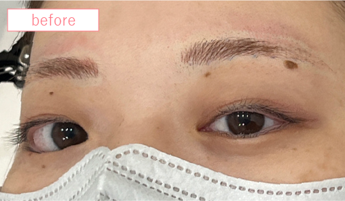 アートメイク症例ビフォアー