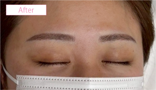 アートメイク症例アフター