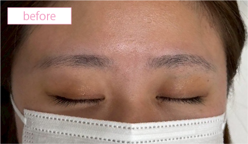 アートメイク症例ビフォアー