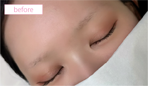 アートメイク症例ビフォアー