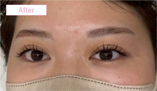 アートメイク症例アフター