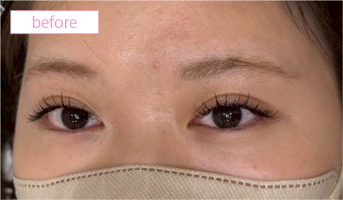 アートメイク症例ビフォアー