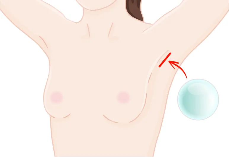 バッグ豊胸ワキ下からの挿入画像