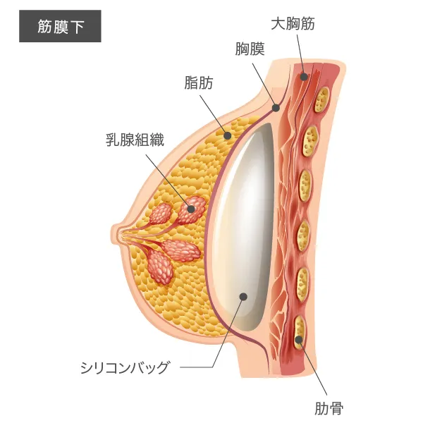 バッグの挿入方法:筋膜下