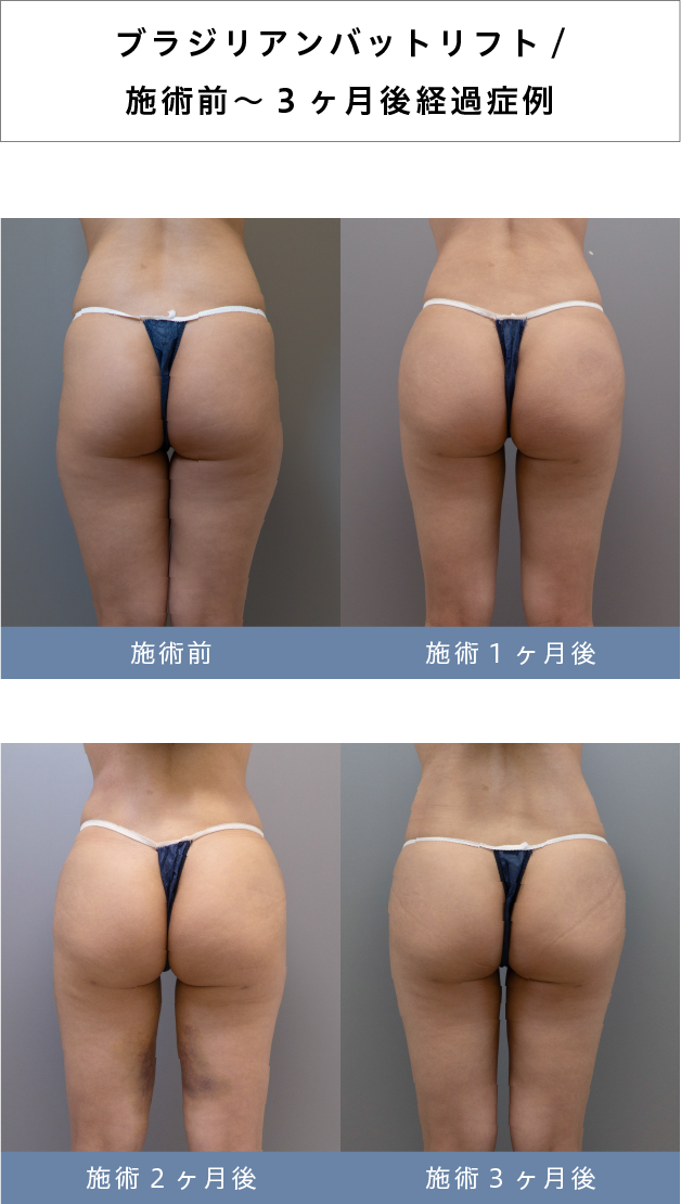 ブラジリアンバットリフト経過症例