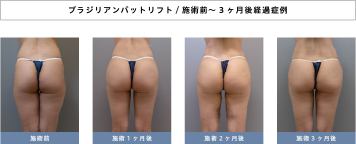 ブラジリアンバットリフト経過症例