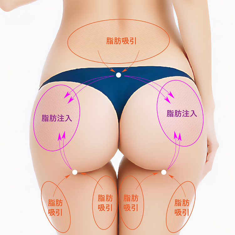 脂肪注入豊胸メインイメージ