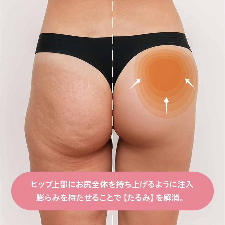 ブラジリアンバットリフト注入イメージ