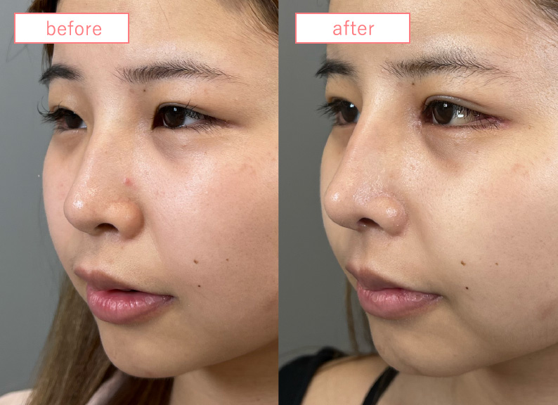 症例写真:団子鼻解消