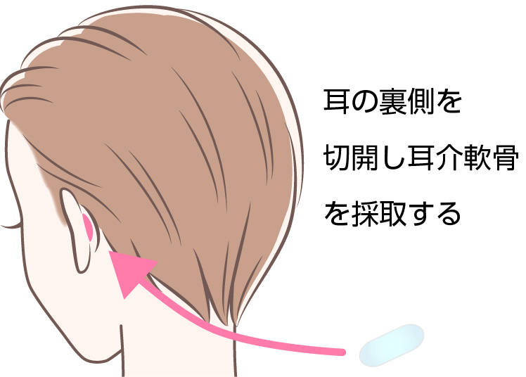 軟骨採取のイメージ