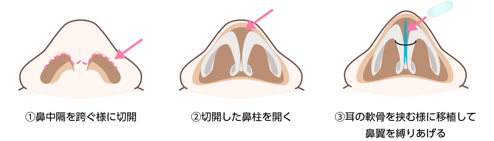 軟骨を挿れるイメージ