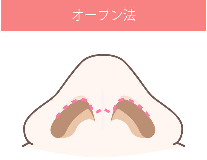 術式の図解:オープン法