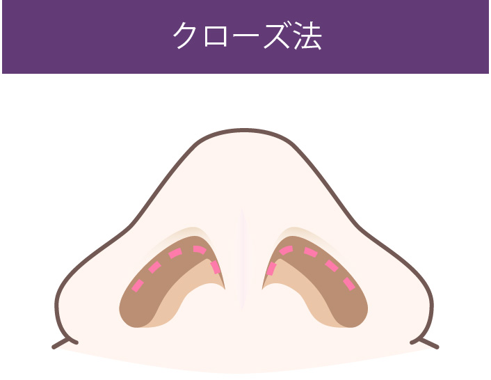 術式の図解:クローズ法