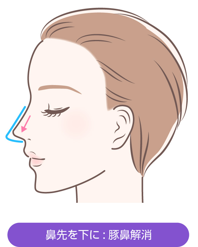 鼻先を下に:豚鼻解消