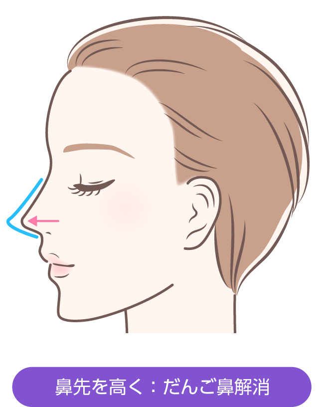 鼻先を高く:だんご鼻解消
