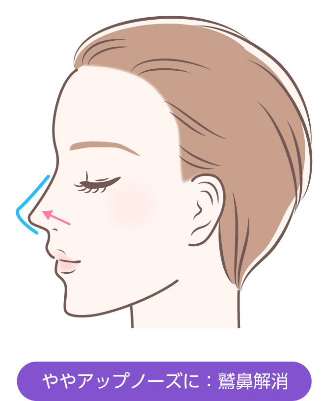 ややアップノーズに:鷲鼻解消