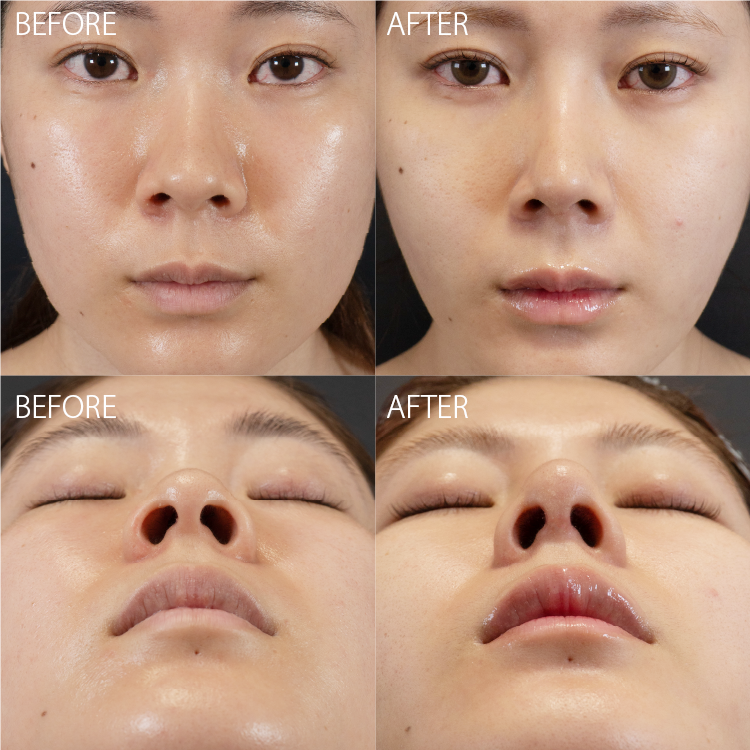 鼻尖形成変化症例画像