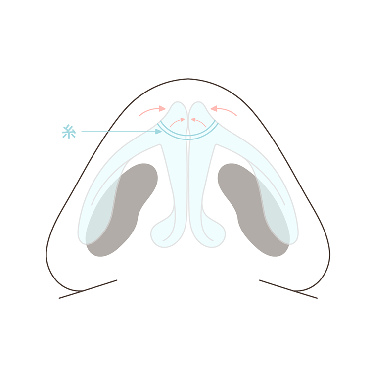 鼻尖縮小クローズ法施術方法