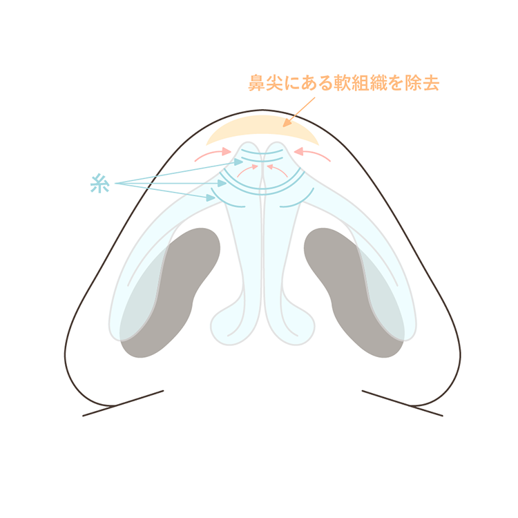 鼻尖縮小クオープン法施術方法