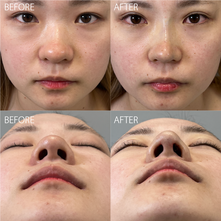 鼻尖縮小症例変化画像