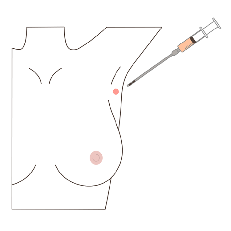 ヒアルロン酸豊胸