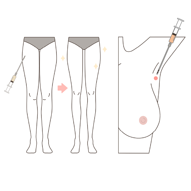 脂肪豊胸イラスト