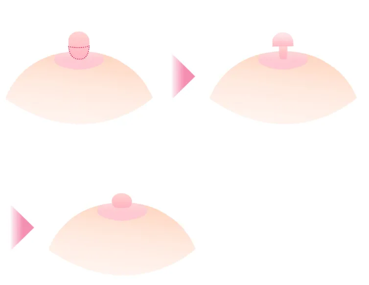 乳頭縮小術イラスト