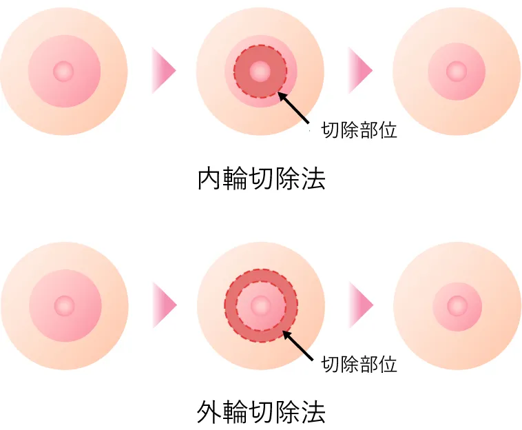 乳輪縮小術イラスト