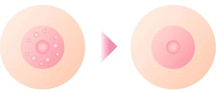 モントゴメリー除去イラスト