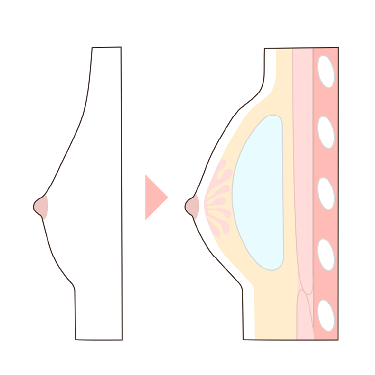 シリコンバッグ豊胸イラスト