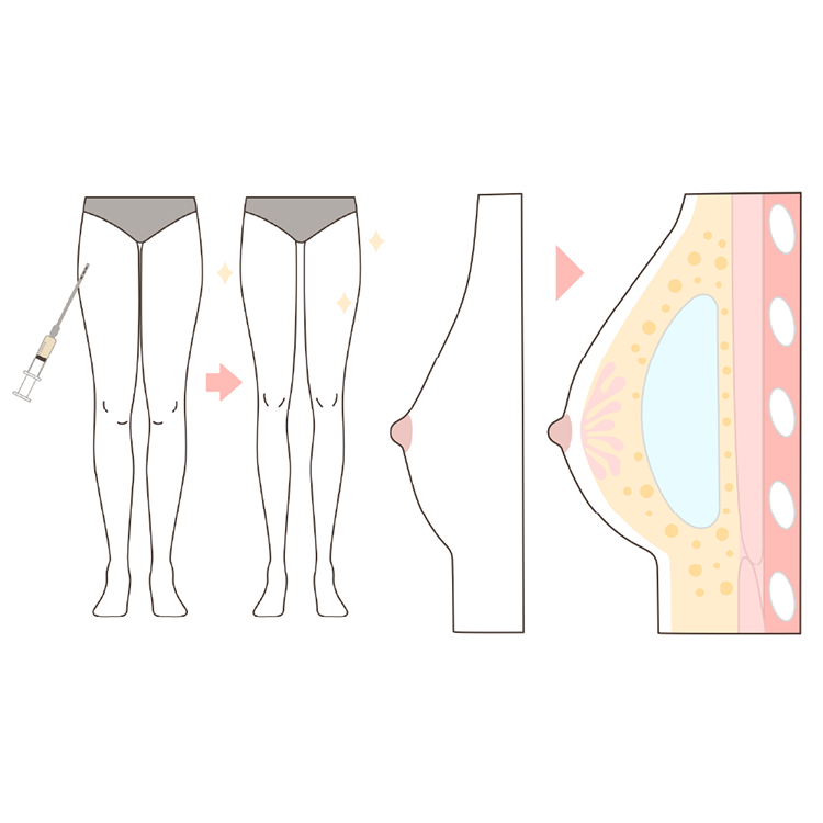 ハイブリッド豊胸イラスト