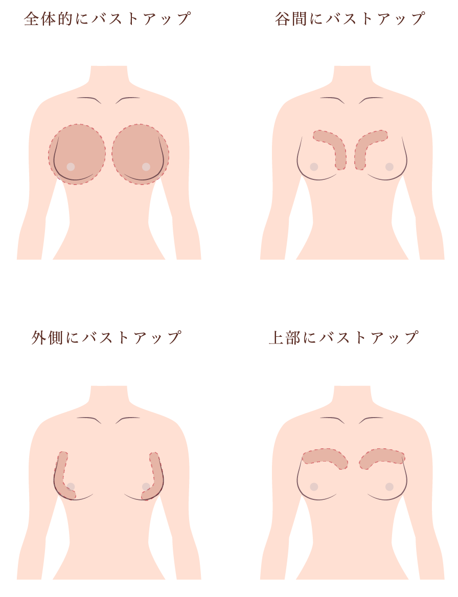脂肪注入豊胸の部分痩せ部位イメージ