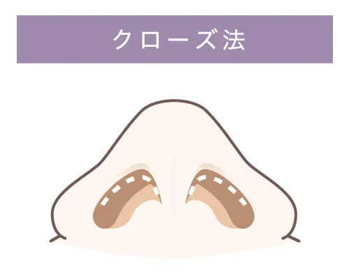 クローズ法イメージ