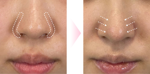 鼻尖縮小効果メージ