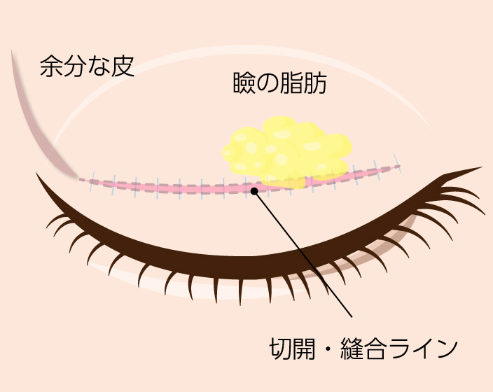 二重整形切開法の施術箇所