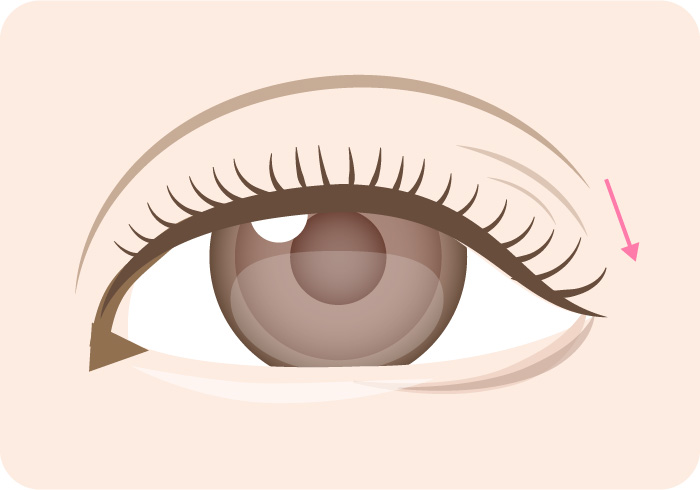 たるみのあるまぶたのイメージ