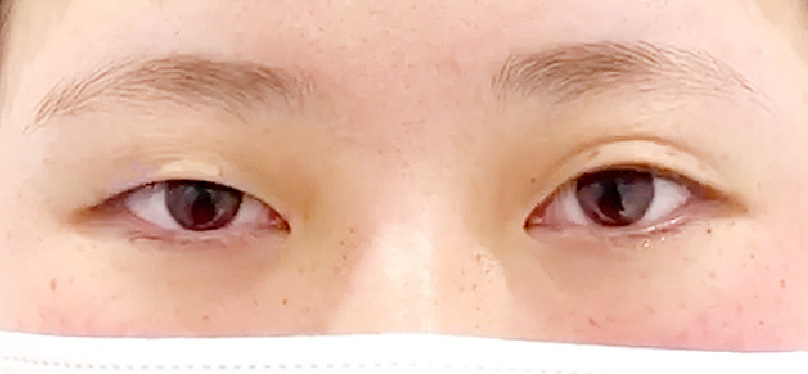 イメージ:まぶたが伸びてしまっている