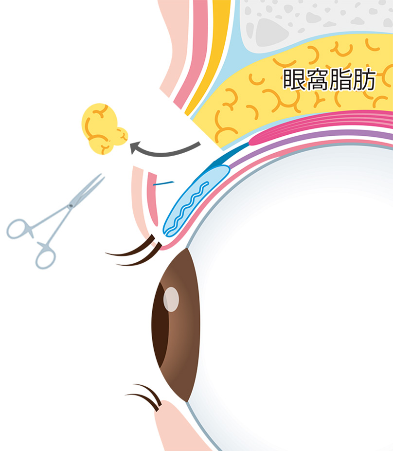 03,脂肪除去の説明画像