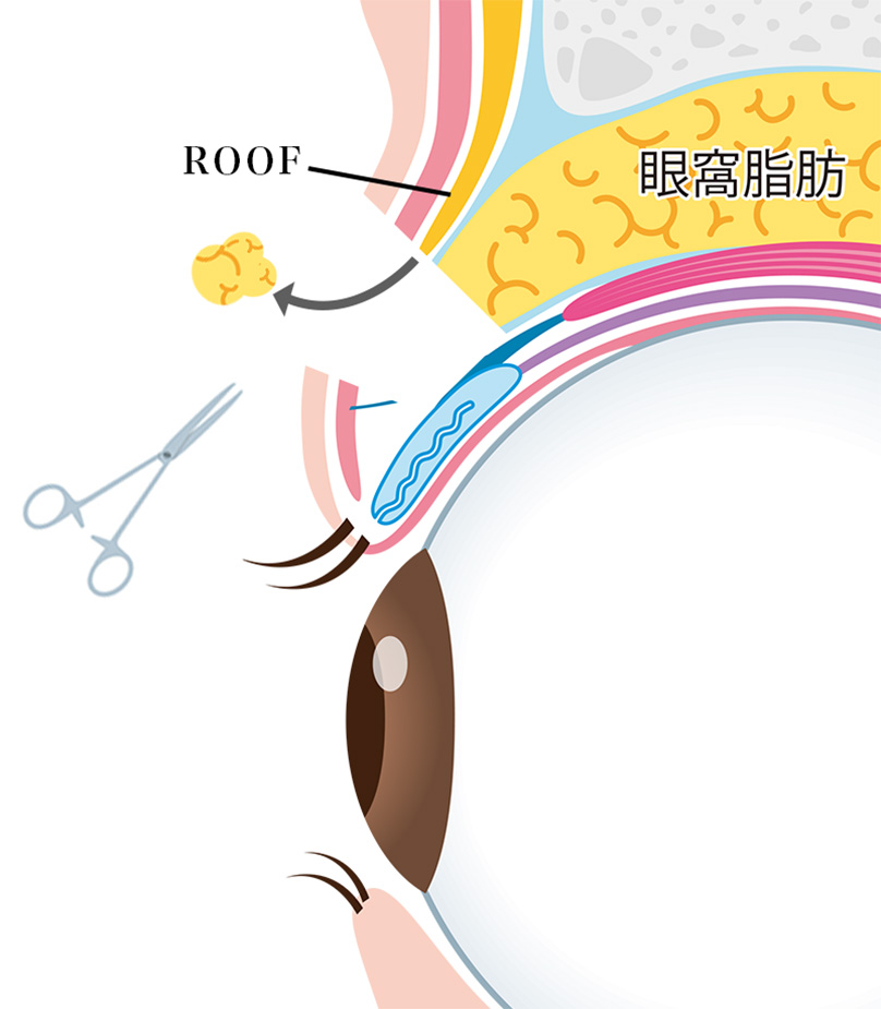 04,ROOF切除の説明画像